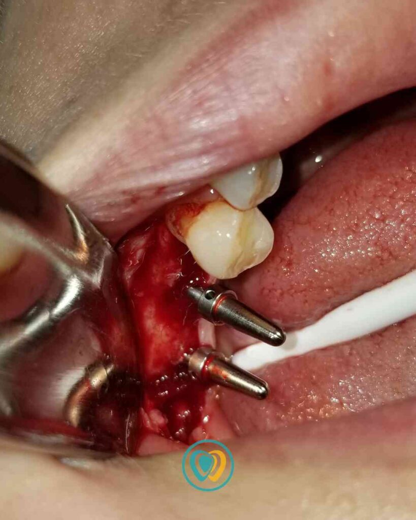 Implantes dentales en Tijuana