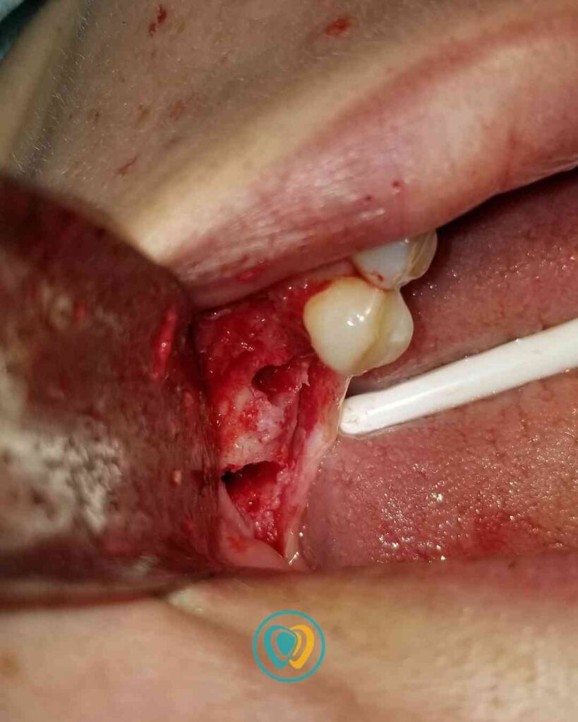 Implantes dentales en Tijuana