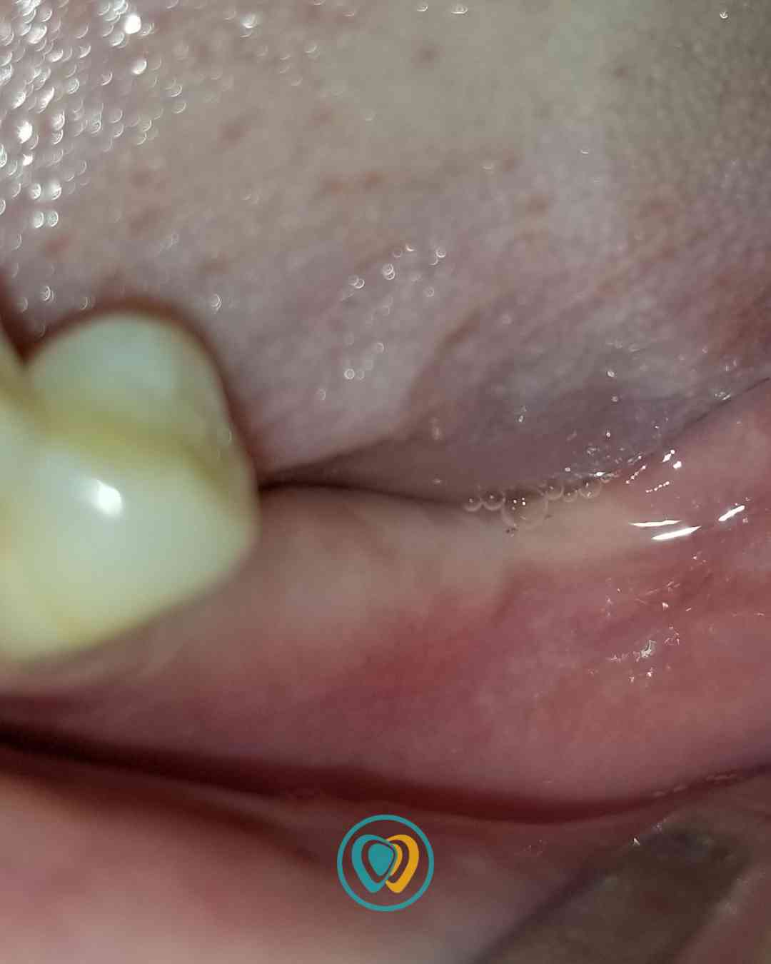 Implantes dentales en Tijuana