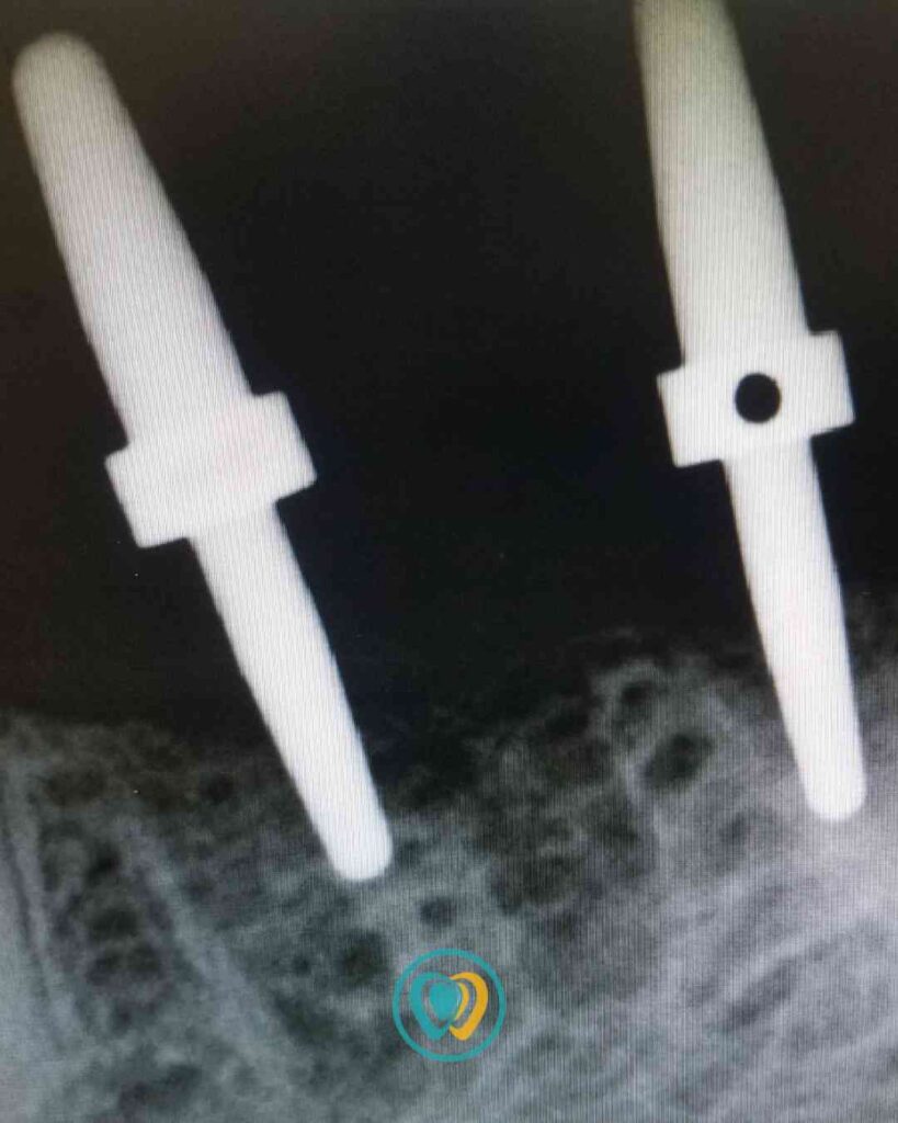 Implantes dentales en Tijuana