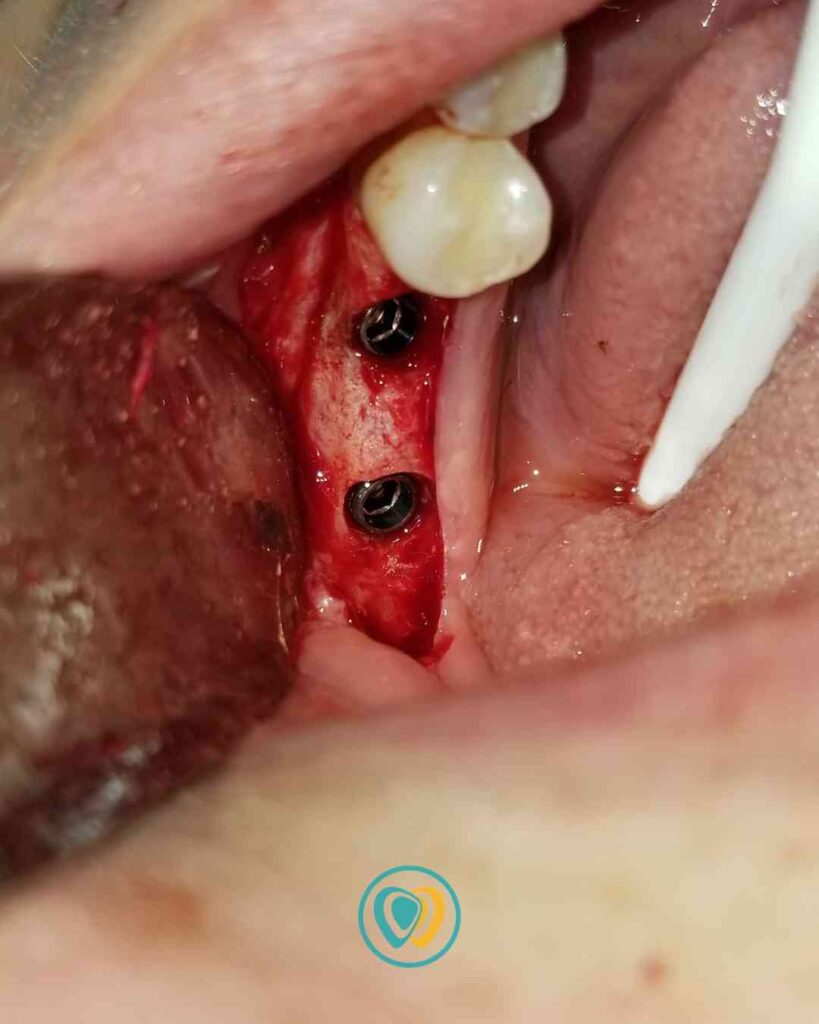 Implantes dentales en Tijuana