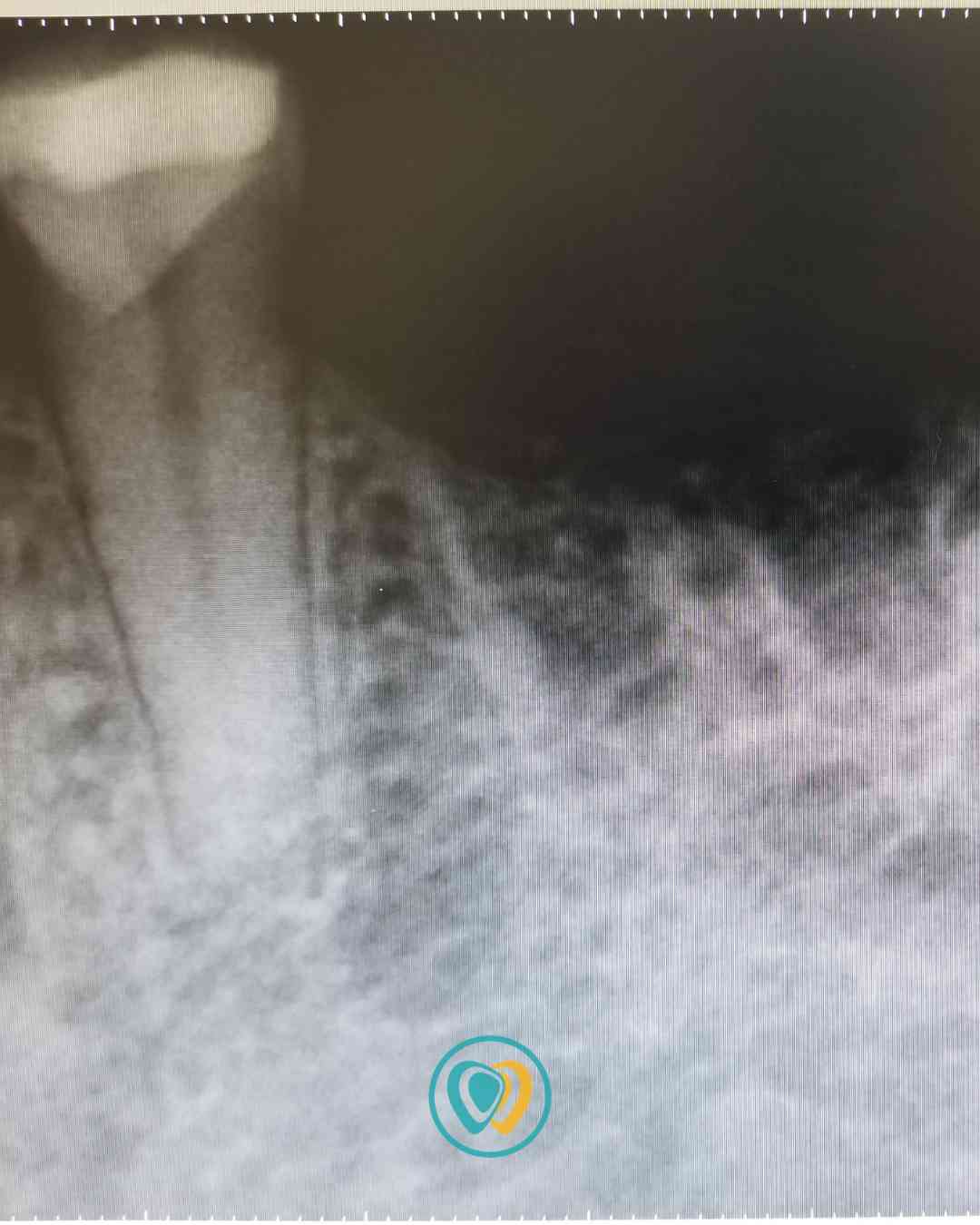 Implantes dentales en Tijuana