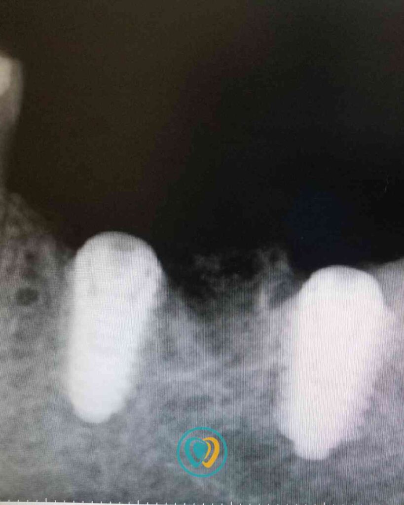 Implantes dentales en Tijuana