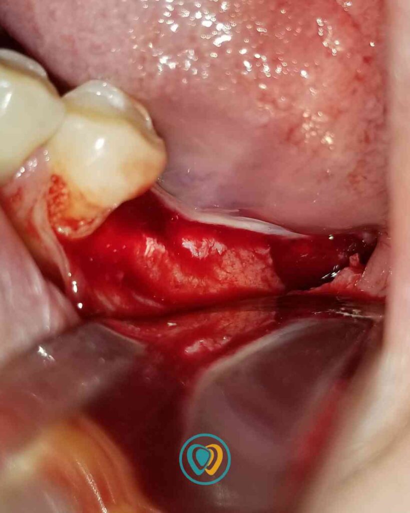 Implantes dentales en Tijuana